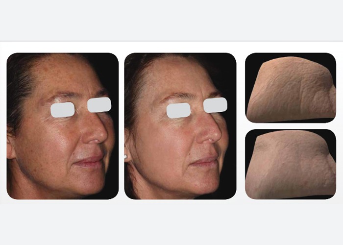 Resurfx laser treatment in Delhi